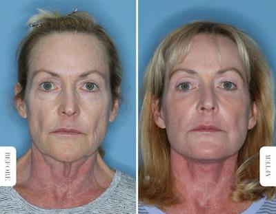 Miami Laser Resurfacing Before & After Gallery - Patient 244971 - Image 1 - The Chopra Plastic Surgery Center