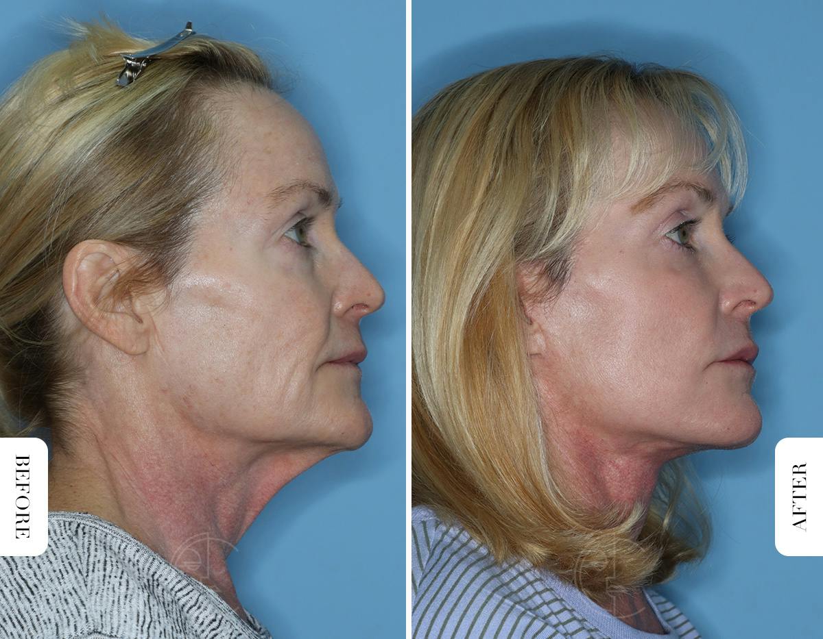 Miami Lower Eyelid Lift Before & After Gallery - Patient 322158 - Image 3 - The Chopra Plastic Surgery Center