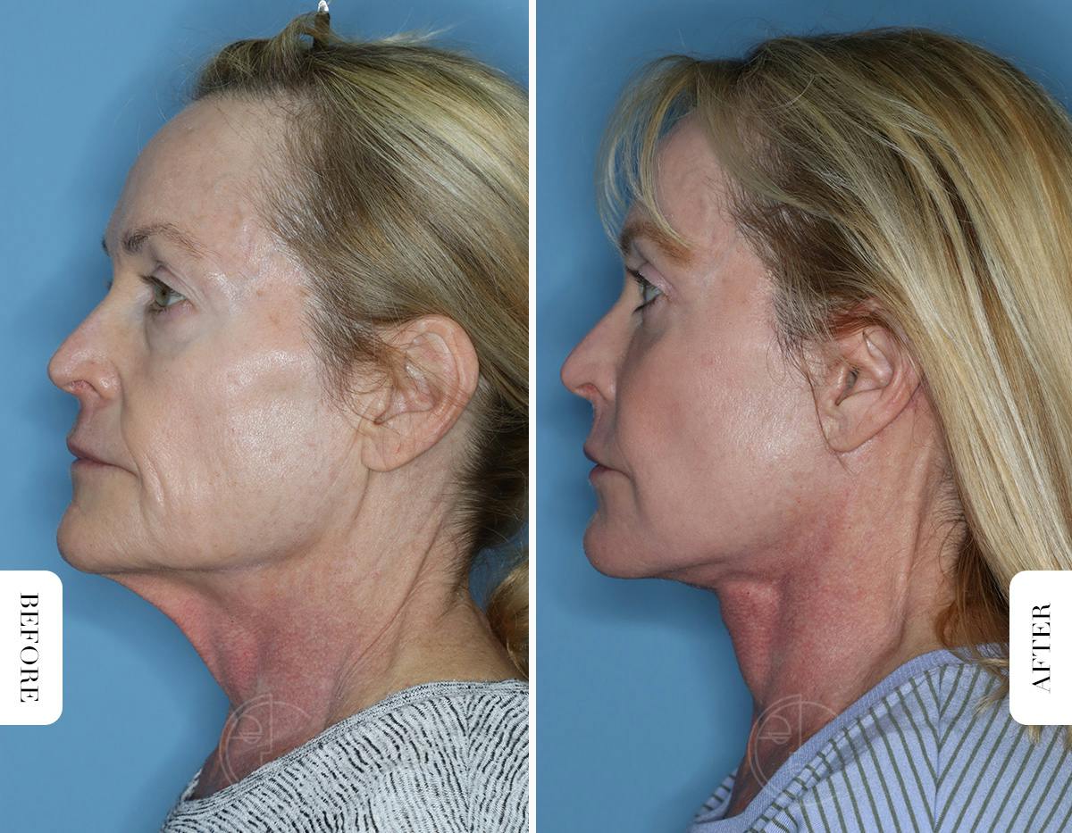 Miami Lower Eyelid Lift Before & After Gallery - Patient 322158 - Image 5 - The Chopra Plastic Surgery Center