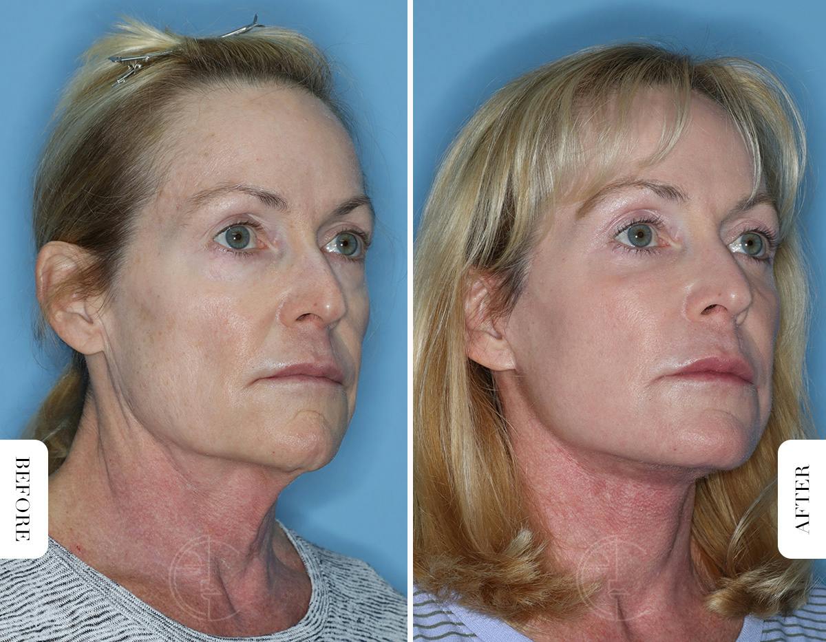Miami Lower Eyelid Lift Before & After Gallery - Patient 322158 - Image 2 - The Chopra Plastic Surgery Center