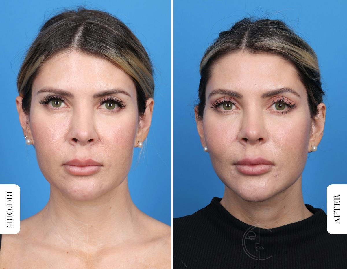 Miami Neck Lift Before & After Gallery - Patient 106814 - Image 1 - The Chopra Plastic Surgery Center