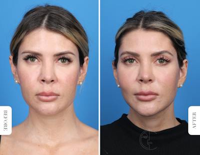 Miami Neck Lift Before & After Gallery - Patient 106814 - Image 1 - The Chopra Plastic Surgery Center