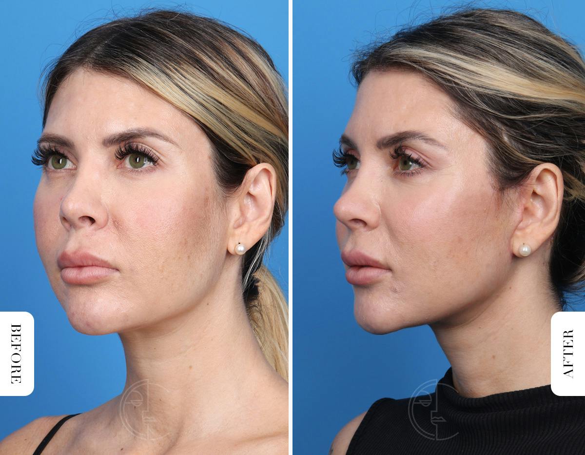 Miami Neck Lift Before & After Gallery - Patient 106814 - Image 3 - The Chopra Plastic Surgery Center