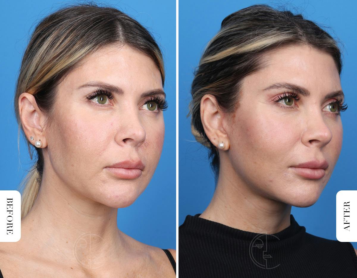 Miami Neck Lift Before & After Gallery - Patient 106814 - Image 2 - The Chopra Plastic Surgery Center