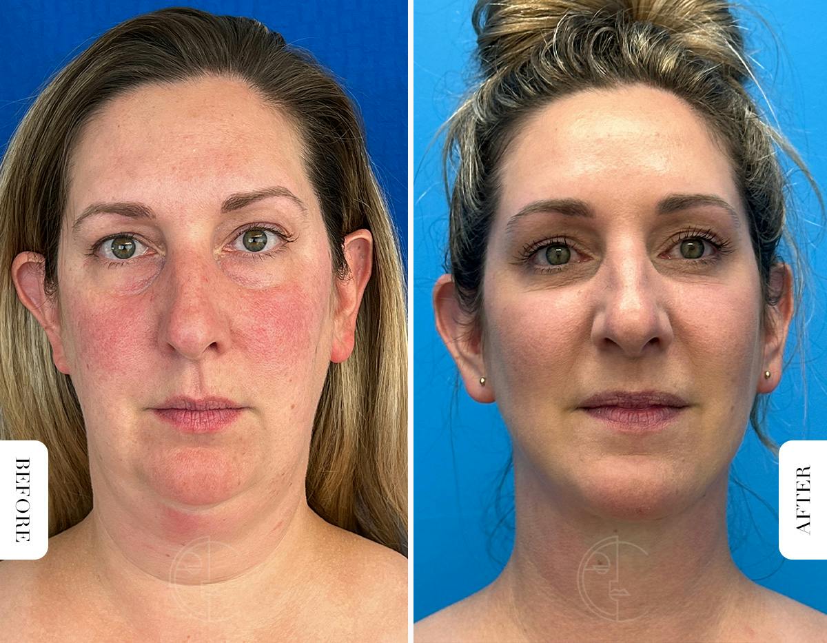 Miami Buccal Fat Pad Removal Before & After Gallery - Patient 722922 - Image 1 - The Chopra Plastic Surgery Center