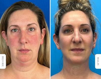 Miami Buccal Fat Pad Removal Before & After Gallery - Patient 722922 - Image 1 - The Chopra Plastic Surgery Center