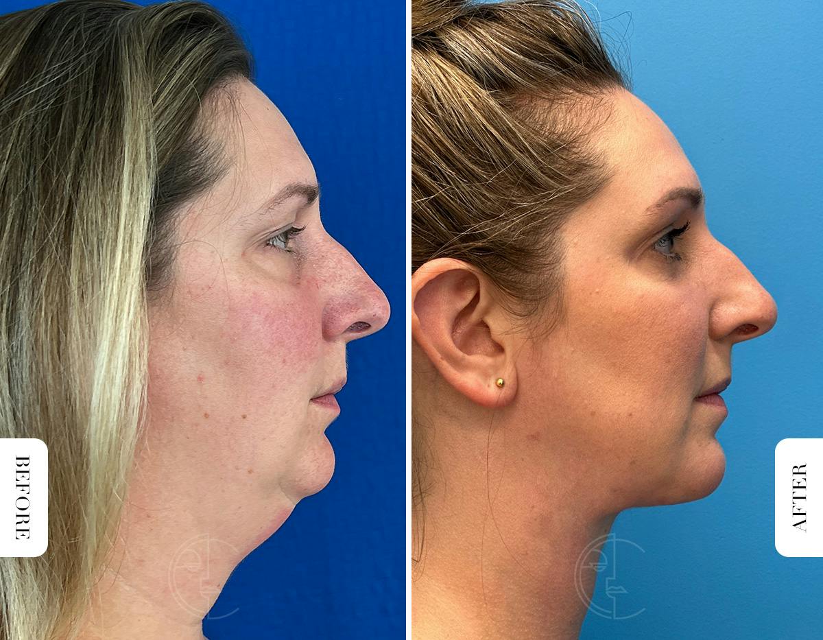 Miami Buccal Fat Pad Removal Before & After Gallery - Patient 722922 - Image 3 - The Chopra Plastic Surgery Center