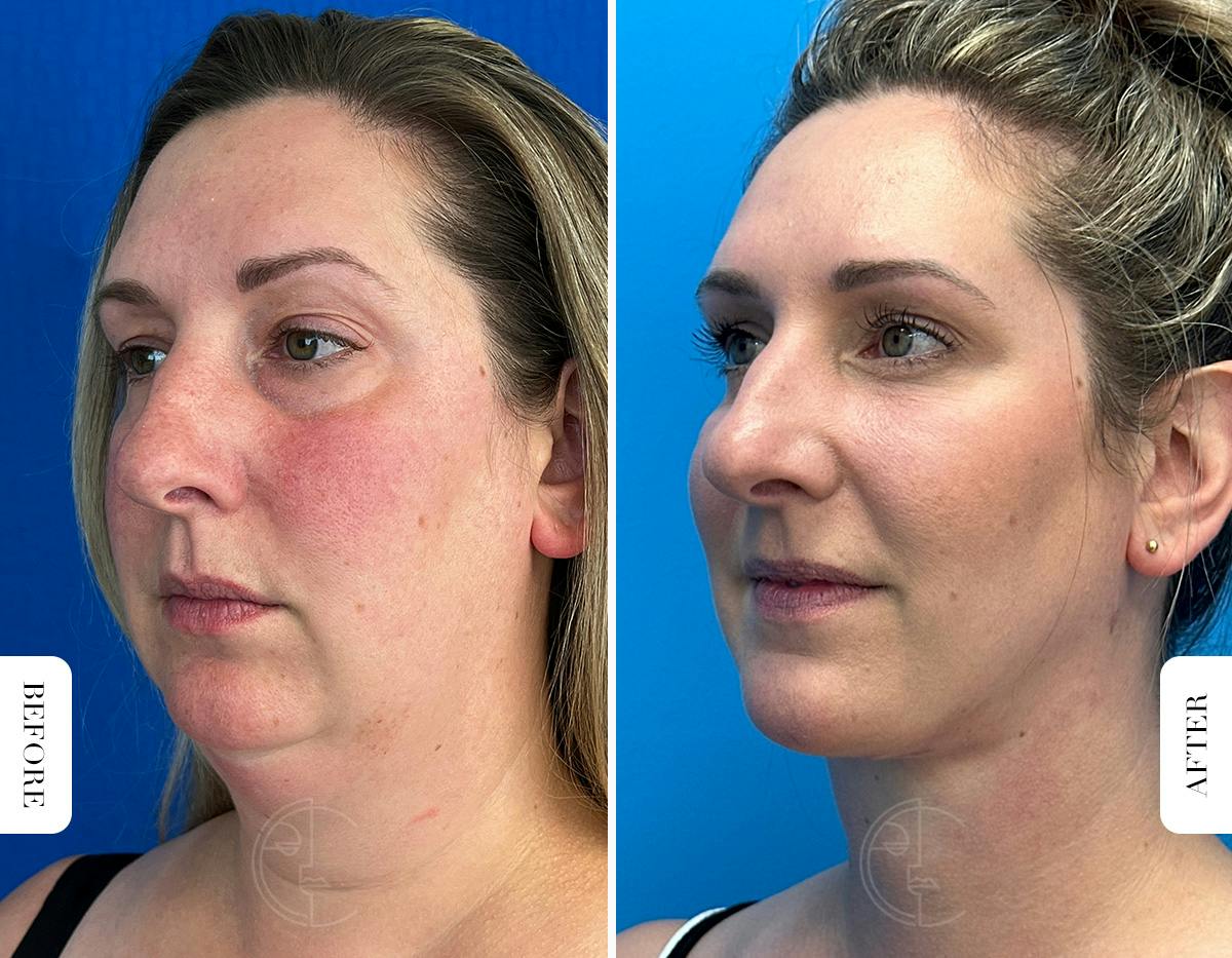 Miami Buccal Fat Pad Removal Before & After Gallery - Patient 722922 - Image 4 - The Chopra Plastic Surgery Center