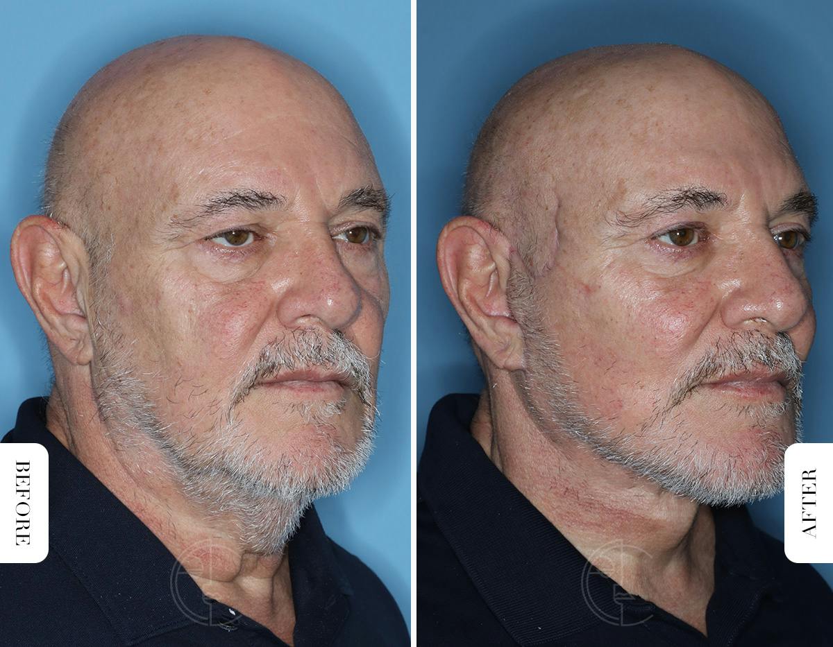 Miami Male Facelift Before & After Gallery - Patient 331471 - Image 2 - The Chopra Plastic Surgery Center
