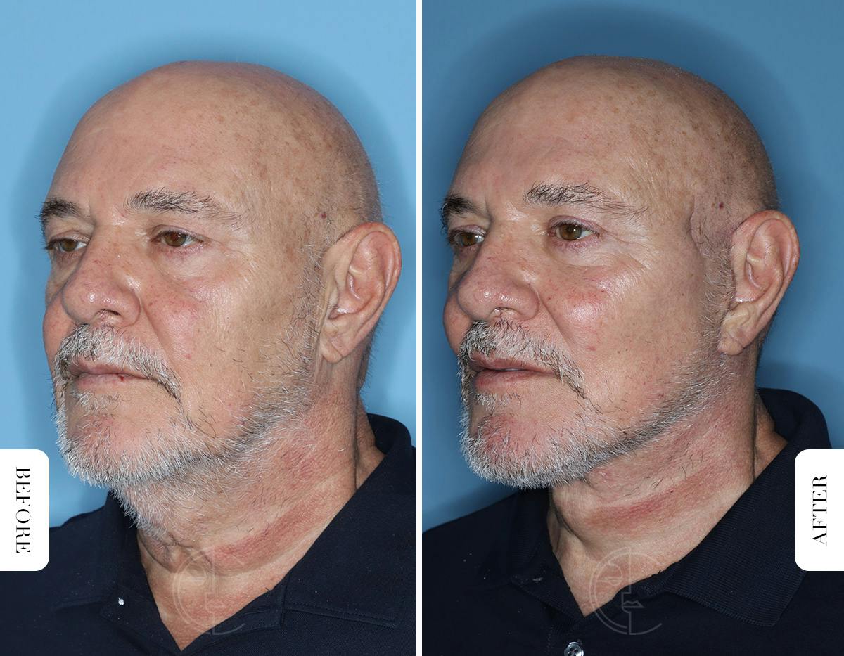 Miami Male Facelift Before & After Gallery - Patient 331471 - Image 4 - The Chopra Plastic Surgery Center