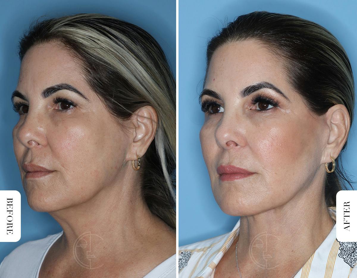 Miami Facelift Before & After Gallery - Patient 329163 - Image 4 - The Chopra Plastic Surgery Center