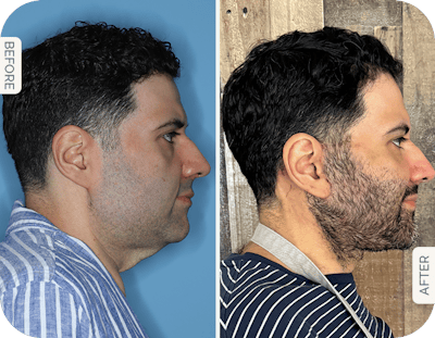 Miami Male Facelift Before & After Gallery - Patient 718254 - Image 1 - The Chopra Plastic Surgery Center