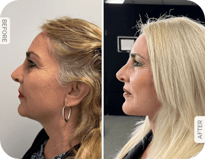 Miami Neck Lift Before & After Gallery - Patient 183024 - Image 1 - The Chopra Plastic Surgery Center