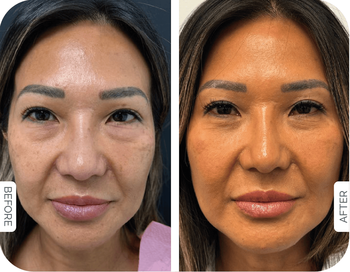 Miami Lower Eyelid Lift Before & After Gallery - Patient 205273 - Image 1 - The Chopra Plastic Surgery Center