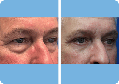 Miami Lower Eyelid Lift Before & After Gallery - Patient 845590 - Image 1 - The Chopra Plastic Surgery Center