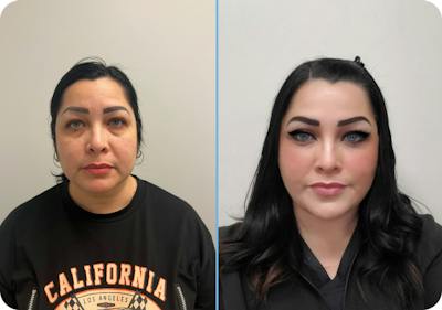 Miami Lower Eyelid Lift Before & After Gallery - Patient 388503 - Image 1 - The Chopra Plastic Surgery Center