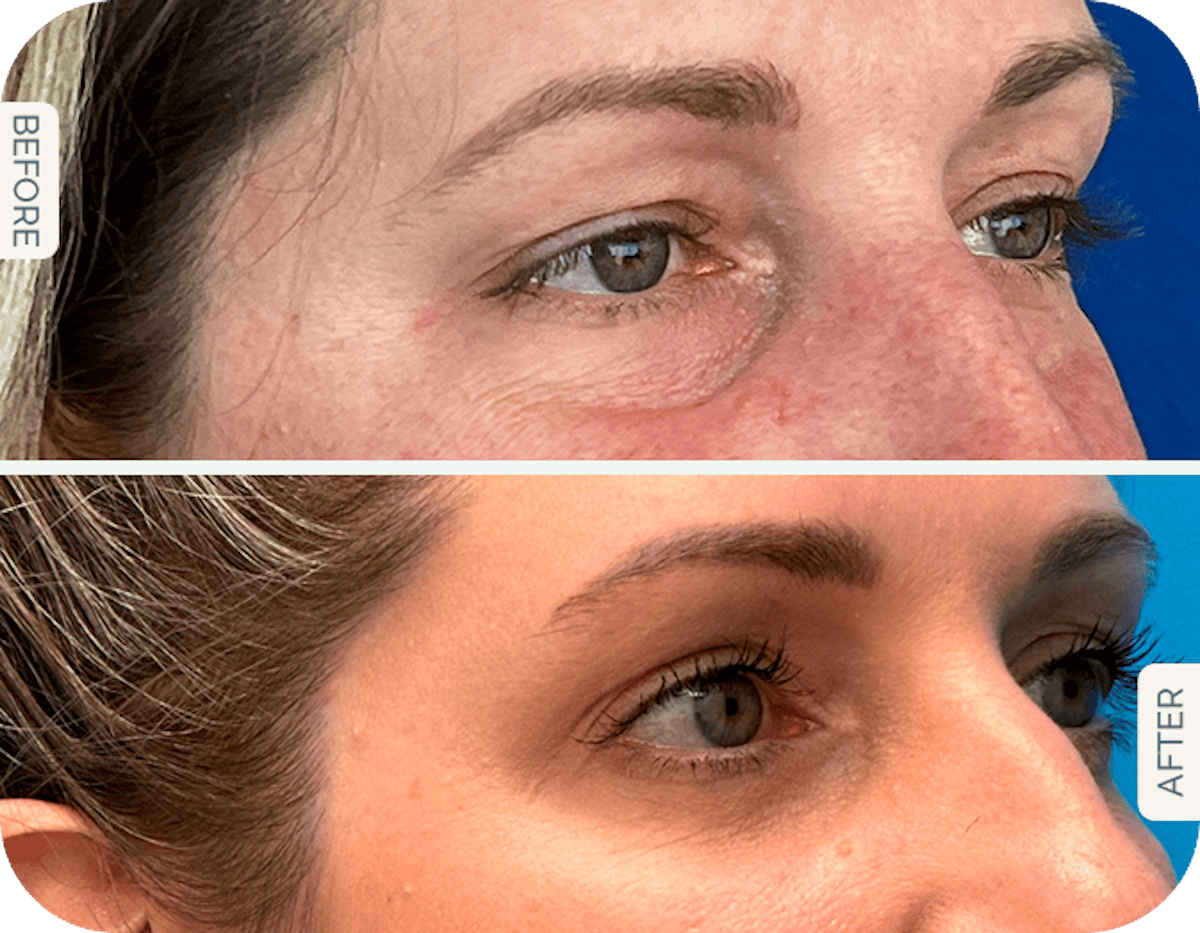 Miami Upper Eyelid Lift Before & After Gallery - Patient 201788 - Image 1 - The Chopra Plastic Surgery Center