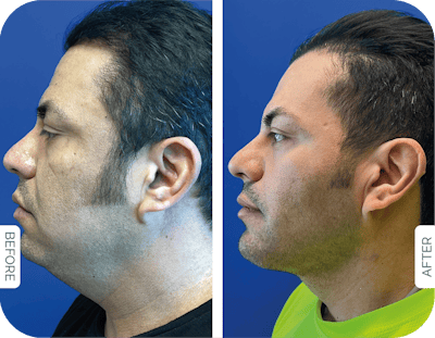 Miami Male Facelift Before & After Gallery - Patient 389842 - Image 1 - The Chopra Plastic Surgery Center