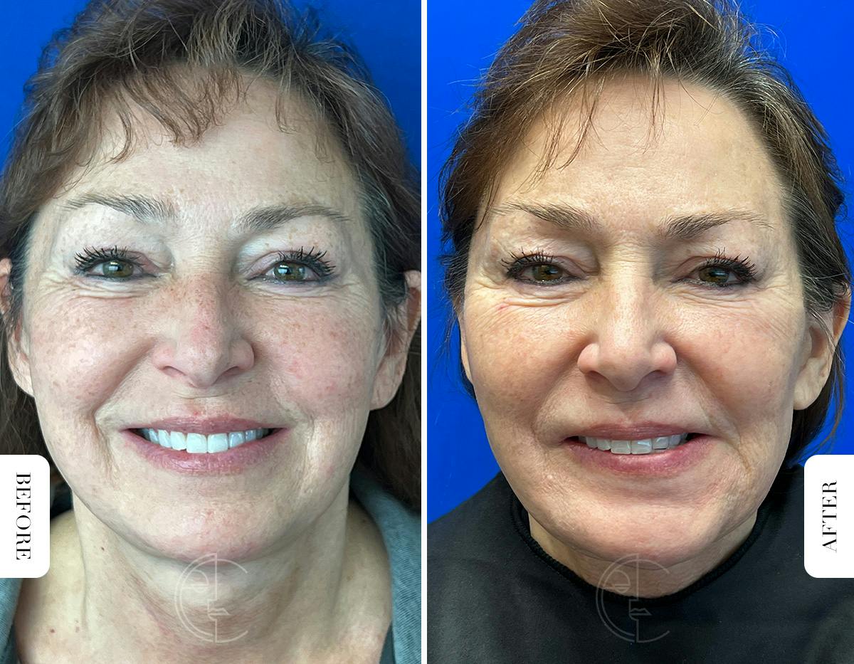 Miami Chin Augmentation Before & After Gallery - Patient 316274 - Image 4 - The Chopra Plastic Surgery Center