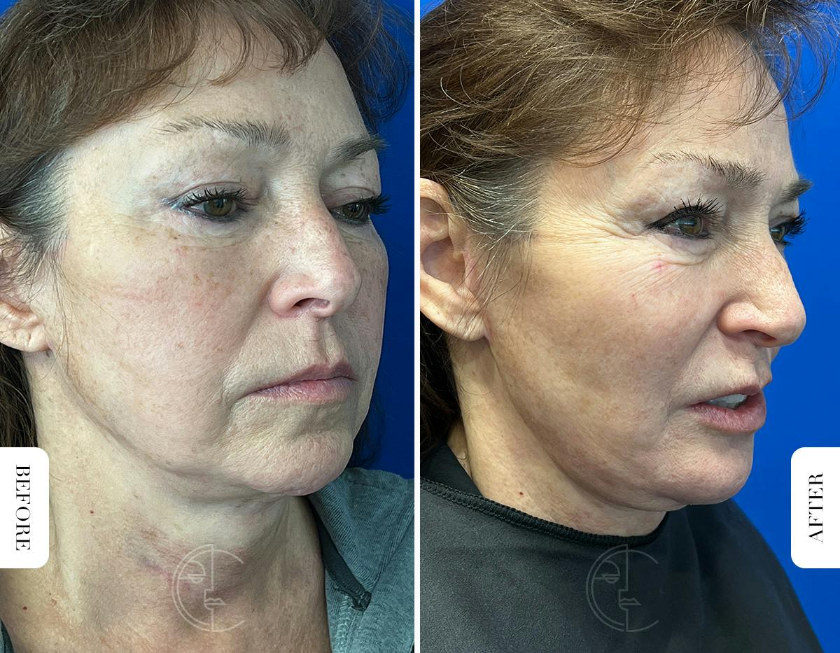 Miami Chin Augmentation Before & After Gallery - Patient 316274 - Image 2 - The Chopra Plastic Surgery Center