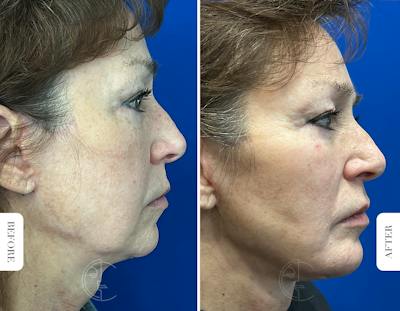 Miami Chin Augmentation Before & After Gallery - Patient 316274 - Image 1 - The Chopra Plastic Surgery Center