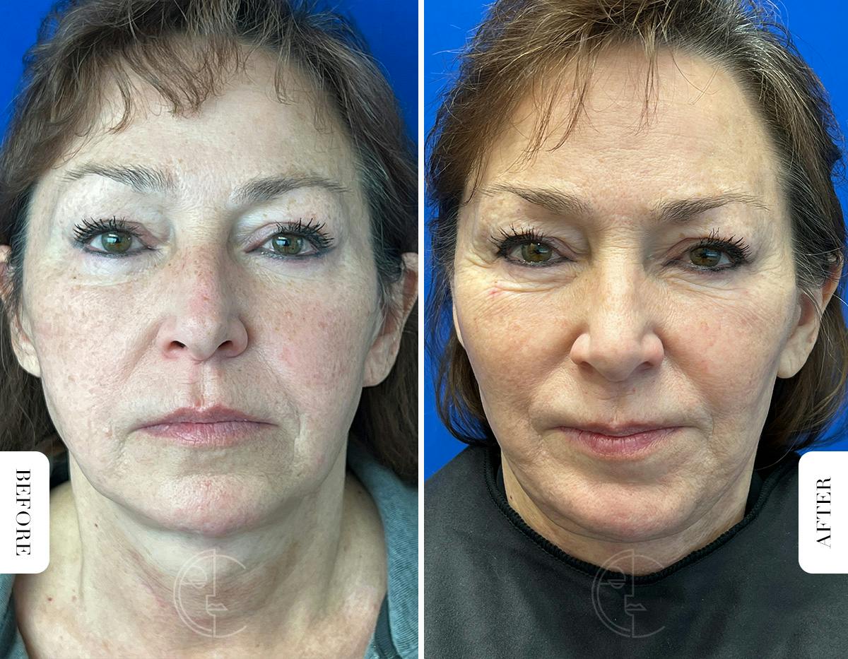 Miami Chin Augmentation Before & After Gallery - Patient 316274 - Image 3 - The Chopra Plastic Surgery Center