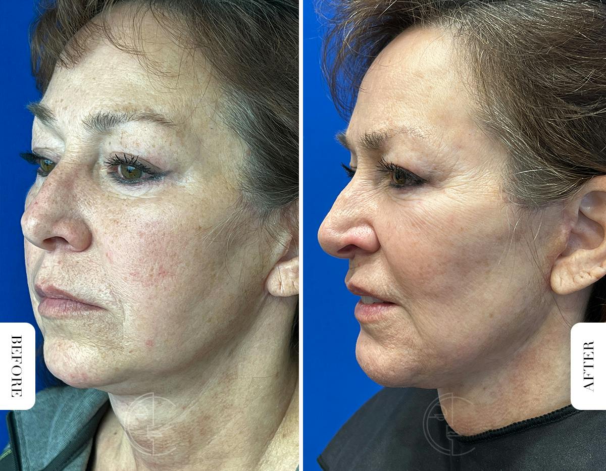 Miami Chin Augmentation Before & After Gallery - Patient 316274 - Image 5 - The Chopra Plastic Surgery Center
