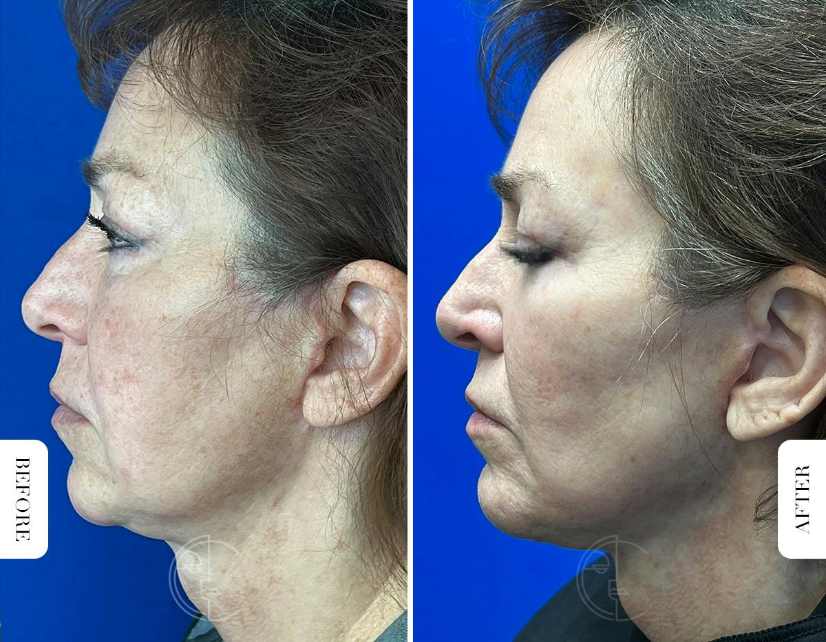 Miami Chin Augmentation Before & After Gallery - Patient 316274 - Image 6 - The Chopra Plastic Surgery Center