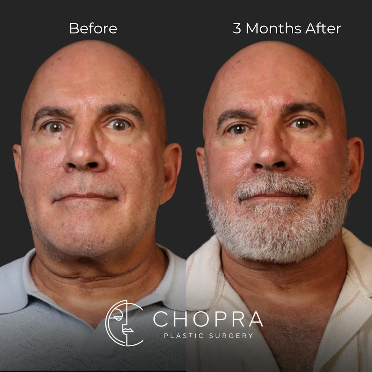 Miami Male Facelift Before & After Gallery - Patient 132477 - Image 1 - The Chopra Plastic Surgery Center
