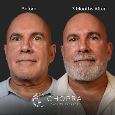 Miami Male Facelift Before & After Gallery - Patient 132477 - Image 1 - The Chopra Plastic Surgery Center
