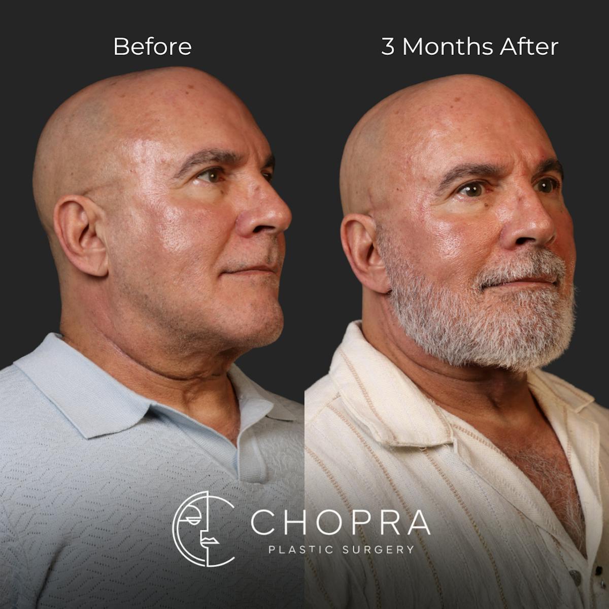 Miami Male Facelift Before & After Gallery - Patient 132477 - Image 5 - The Chopra Plastic Surgery Center