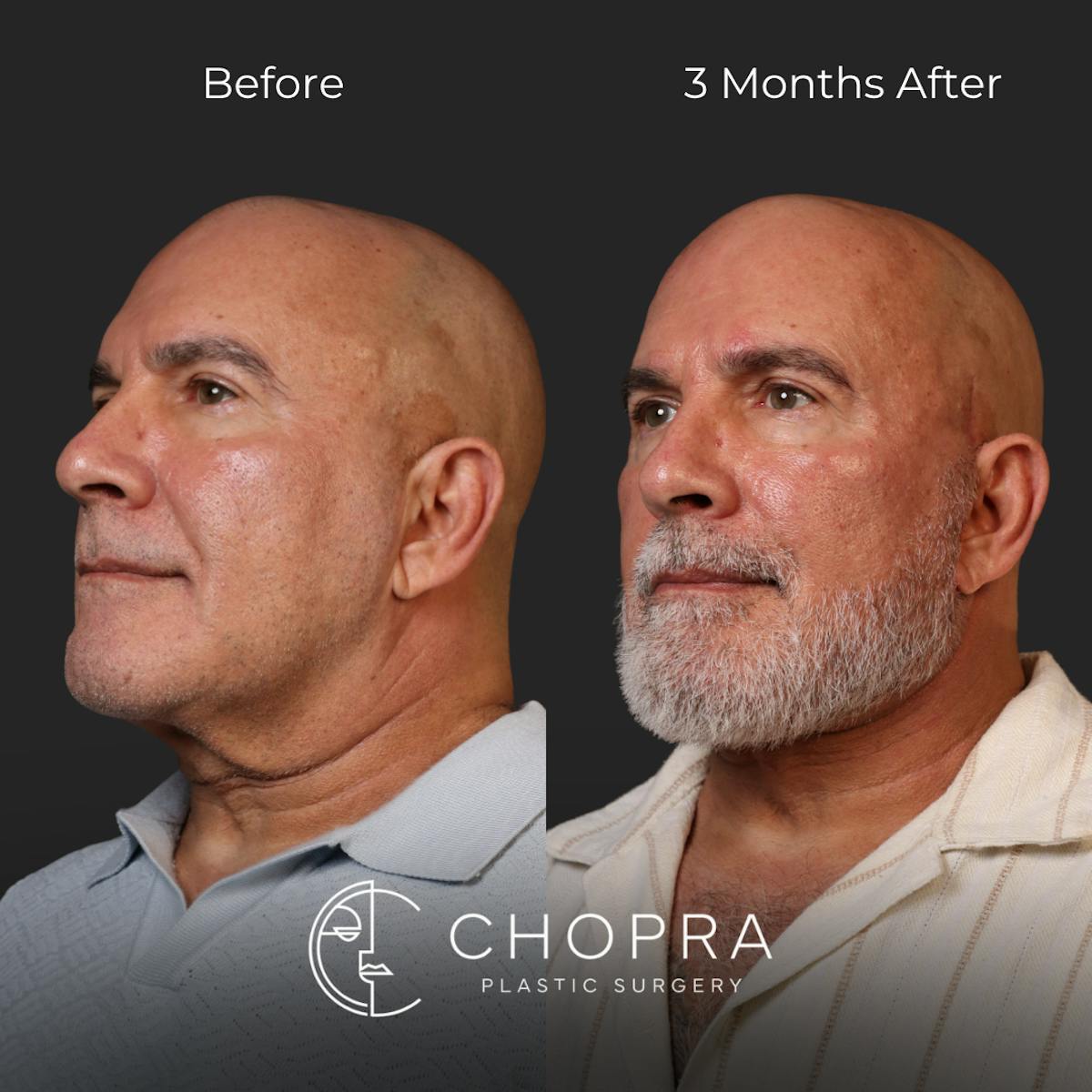Miami Male Facelift Before & After Gallery - Patient 132477 - Image 3 - The Chopra Plastic Surgery Center