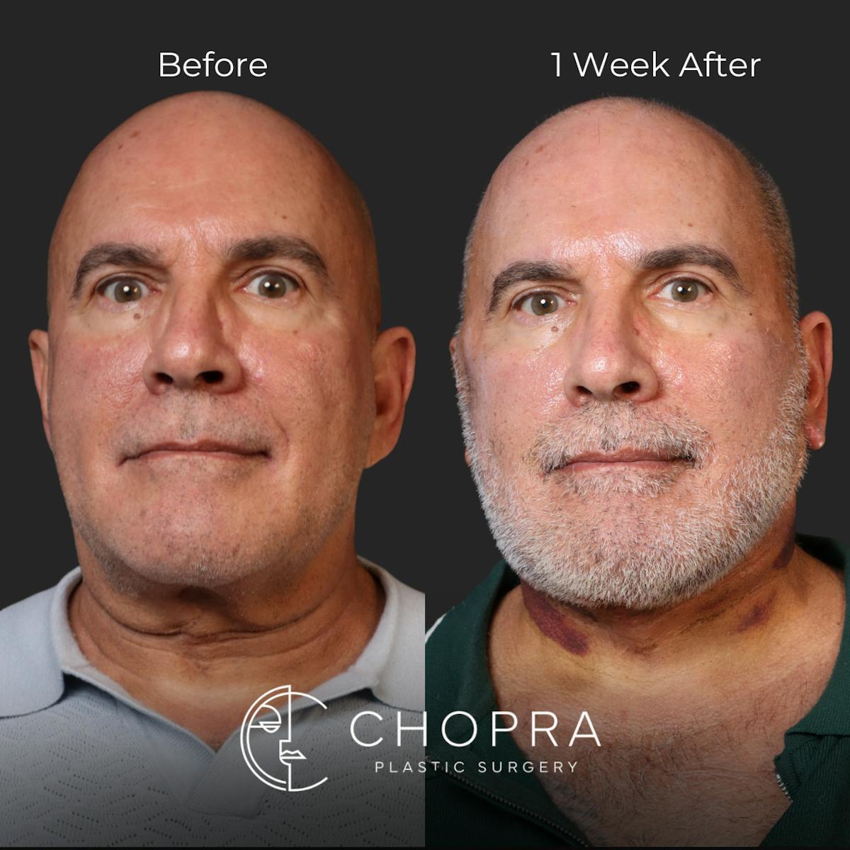Miami Male Facelift Before & After Gallery - Patient 132477 - Image 2 - The Chopra Plastic Surgery Center