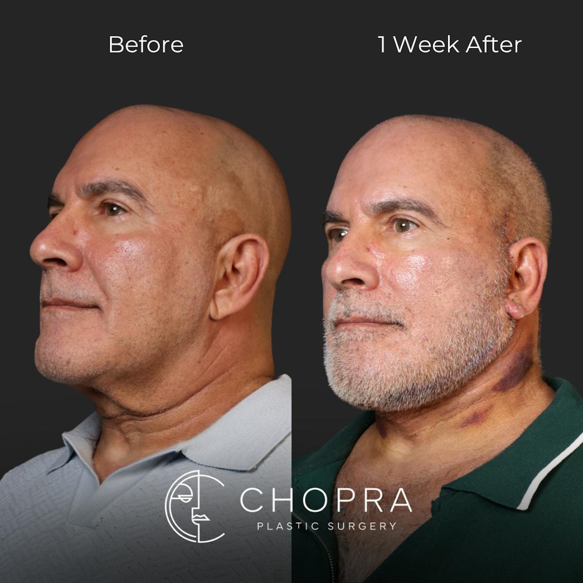 Miami Male Facelift Before & After Gallery - Patient 132477 - Image 4 - The Chopra Plastic Surgery Center