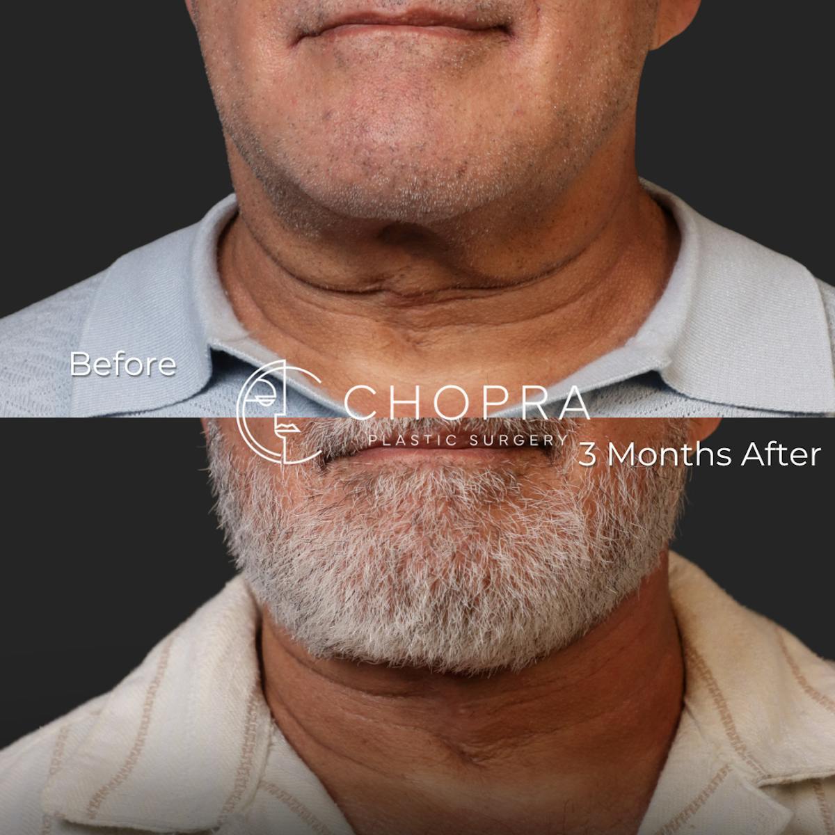 Miami Male Facelift Before & After Gallery - Patient 132477 - Image 6 - The Chopra Plastic Surgery Center