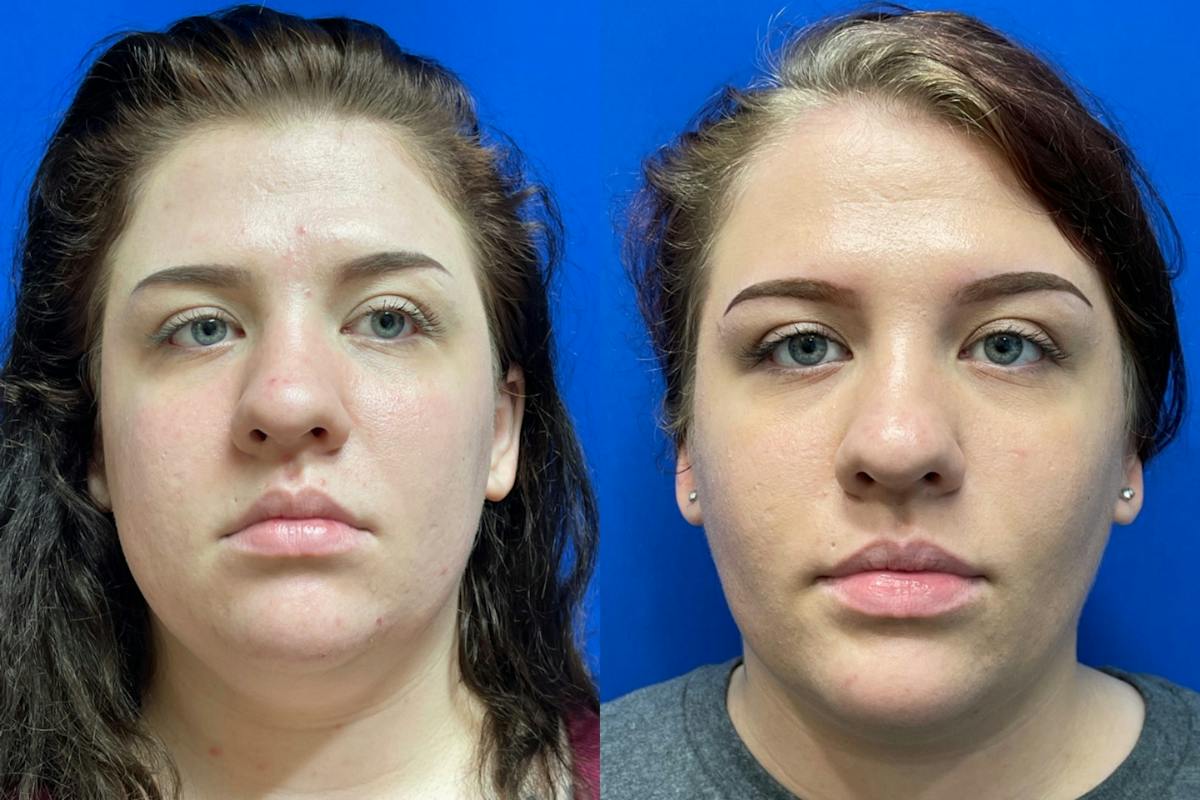 Miami Before and after photo of a 21-year-old female patient who underwent buccal fat pad reduction with Karan Chopra, MD at Chopra Plastic Surgery. The front view demonstrates facial slimming and improvement in lower-cheek fullness. - The Chopra Plastic Surgery Center