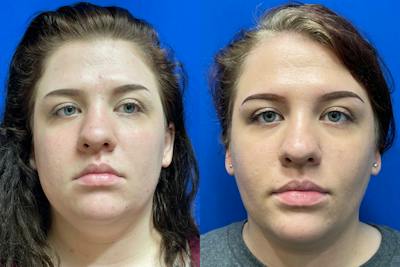 Miami Before and after photo of a 21-year-old female patient who underwent buccal fat pad reduction with Karan Chopra, MD at Chopra Plastic Surgery. The front view demonstrates facial slimming and improvement in lower-cheek fullness. - The Chopra Plastic Surgery Center