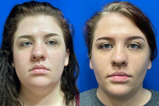 Before and after photo of a 21-year-old female patient who underwent buccal fat pad reduction with Karan Chopra, MD at Chopra Plastic Surgery. The front view demonstrates facial slimming and improvement in lower-cheek fullness.