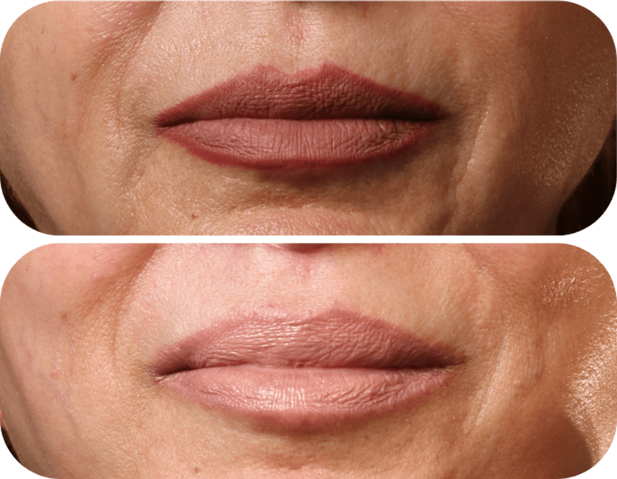 Miami Lip Lift Before & After Gallery - Patient 570911 - Image 1 - The Chopra Plastic Surgery Center