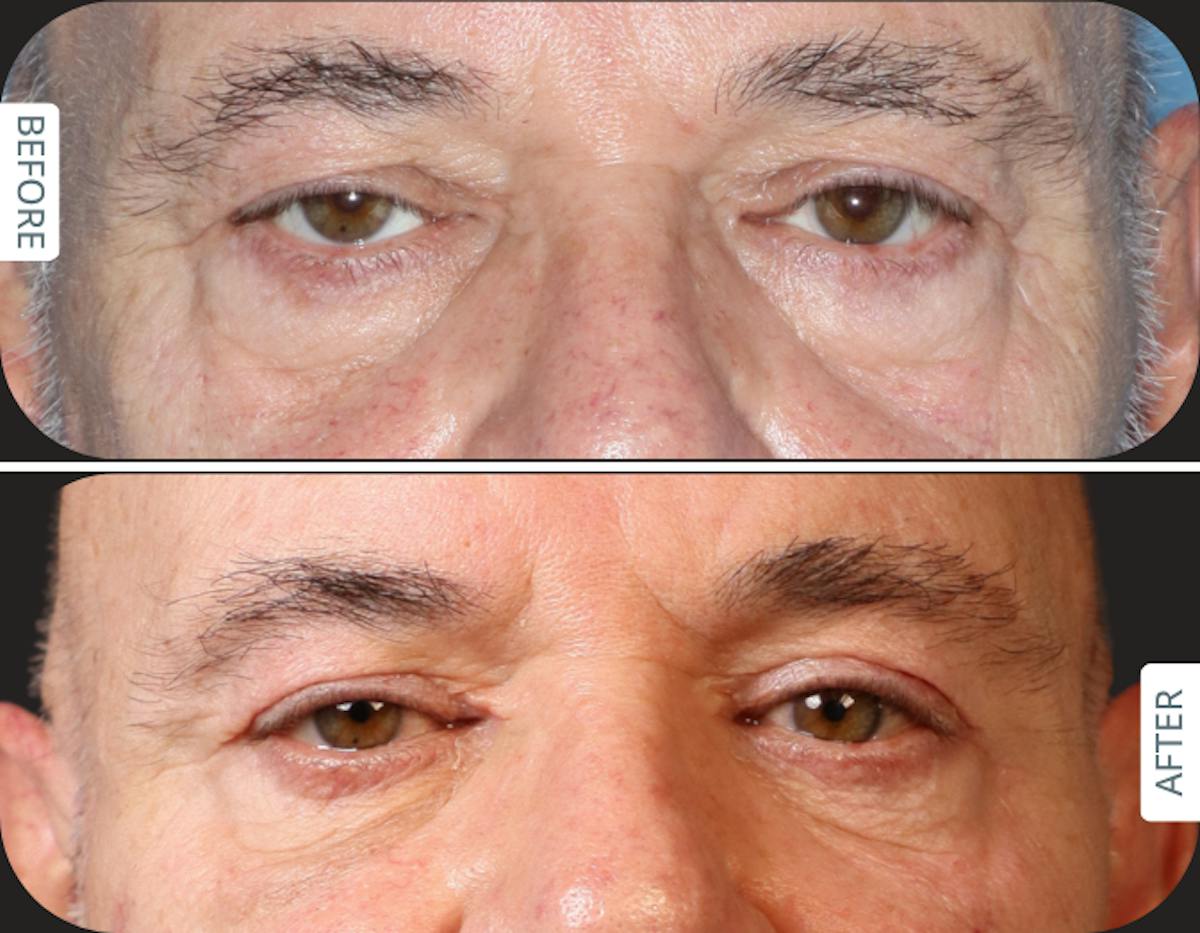 Miami Upper Eyelid Lift Before & After Gallery - Patient 421485 - Image 1 - The Chopra Plastic Surgery Center