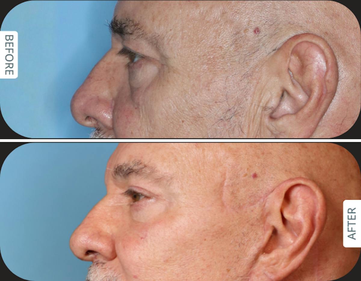 Miami Upper Eyelid Lift Before & After Gallery - Patient 421485 - Image 3 - The Chopra Plastic Surgery Center