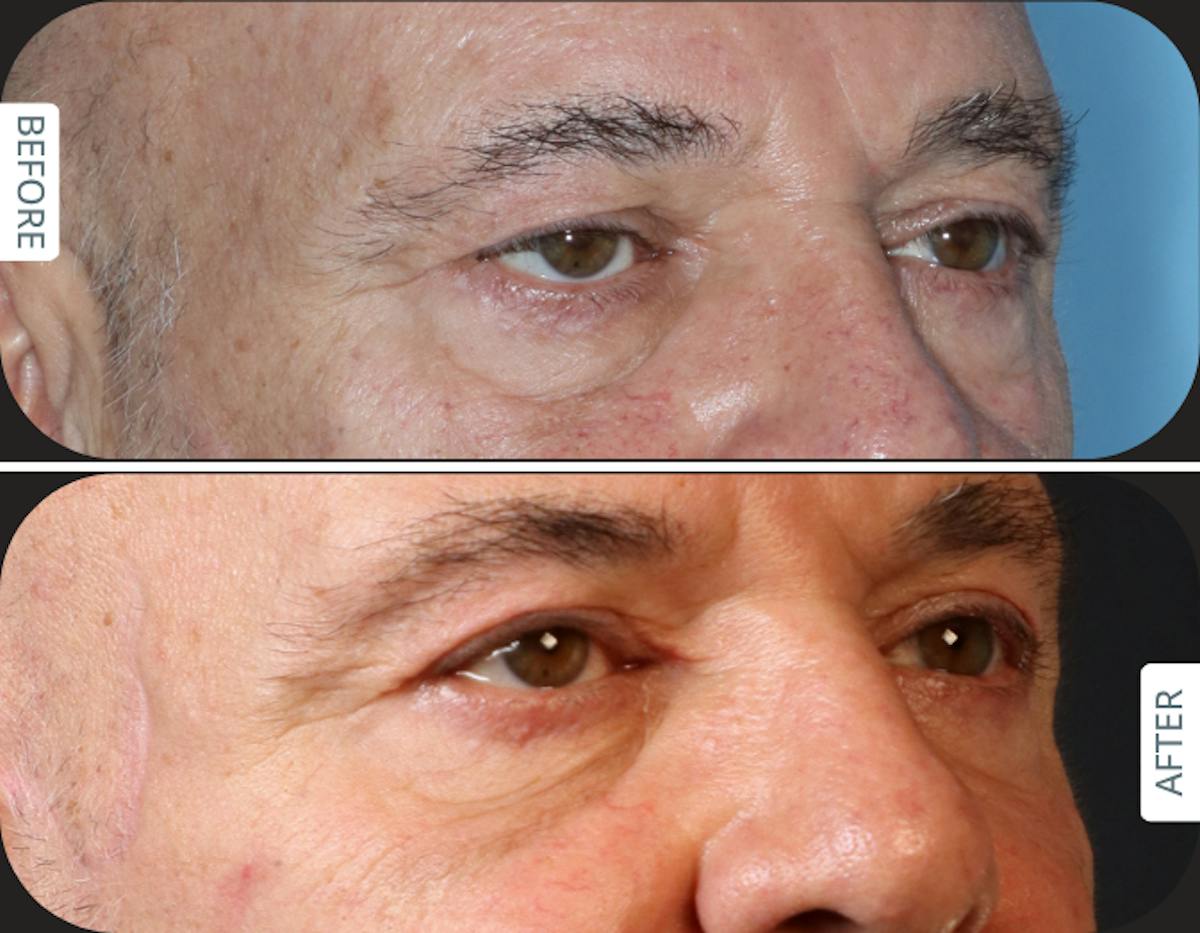 Miami Upper Eyelid Lift Before & After Gallery - Patient 421485 - Image 2 - The Chopra Plastic Surgery Center