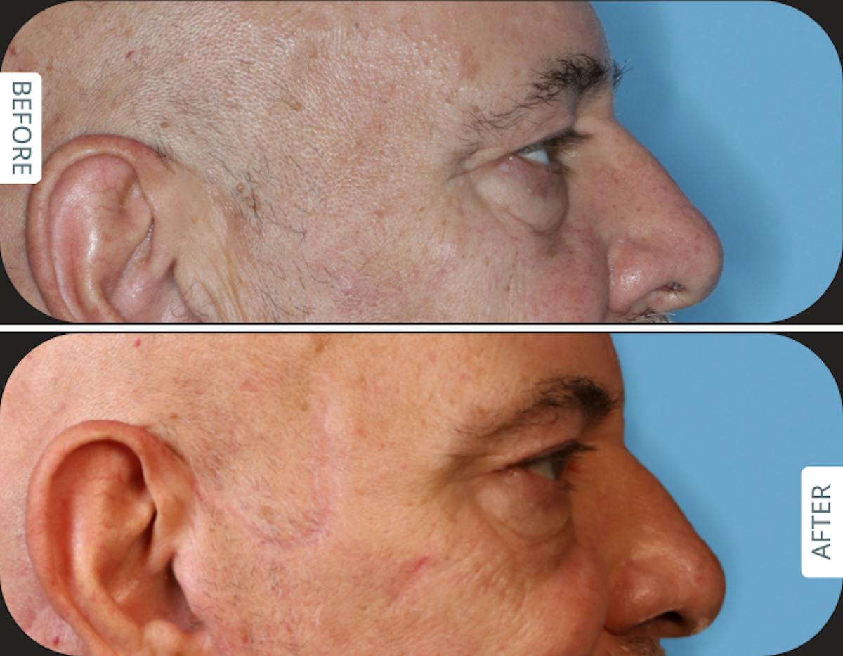 Miami Upper Eyelid Lift Before & After Gallery - Patient 421485 - Image 4 - The Chopra Plastic Surgery Center