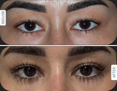 Miami Upper Eyelid Lift Before & After Gallery - Patient 807853 - Image 1 - The Chopra Plastic Surgery Center