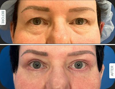 Miami Upper Eyelid Lift Before & After Gallery - Patient 330430 - Image 1 - The Chopra Plastic Surgery Center