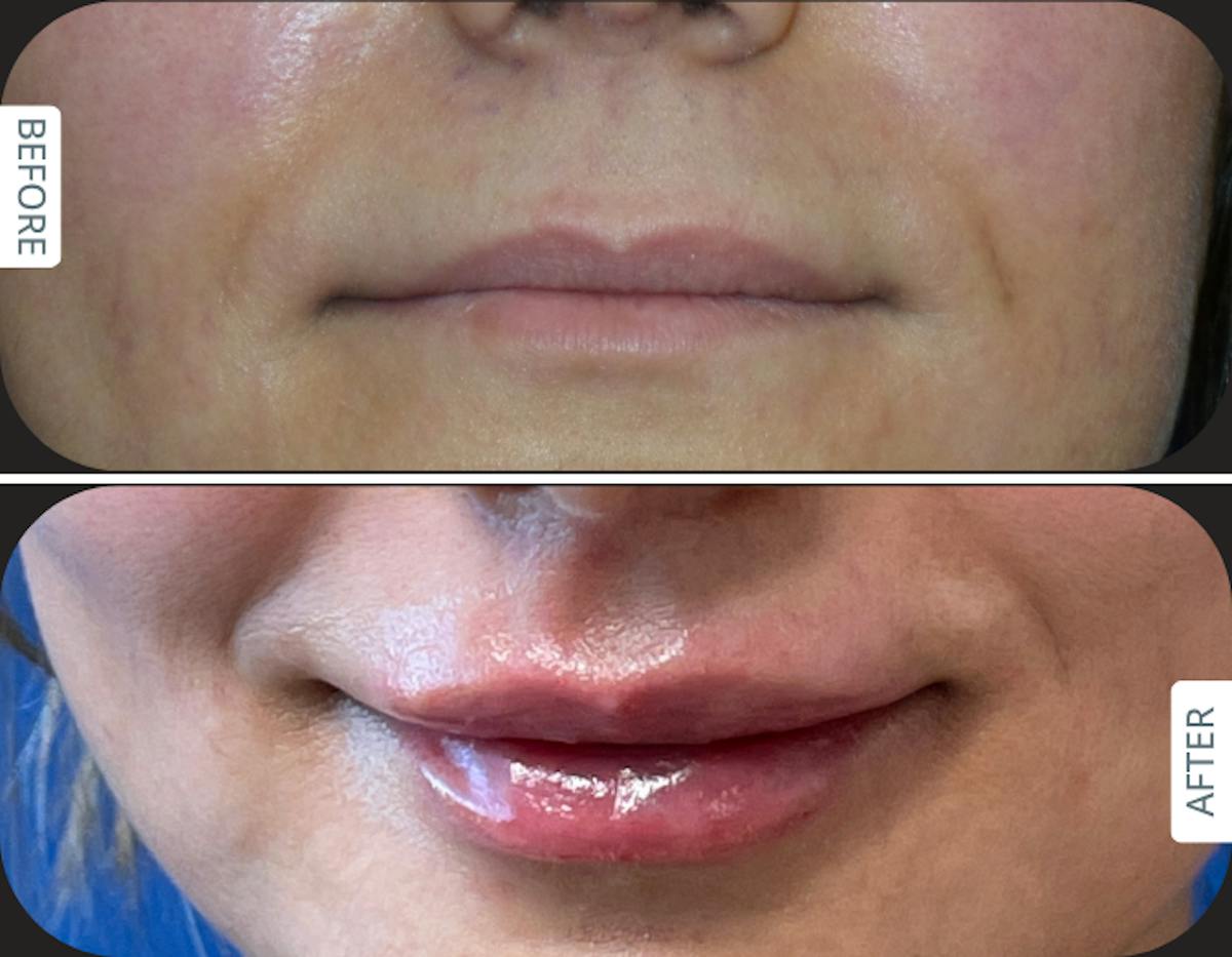 Miami Before and after Designer Deep Plane Lip Lift with fat transfer for natural lip volume enhancement in an international patient treated by Dr. Karan Chopra at Chopra Plastic Surgery in Miami. - The Chopra Plastic Surgery Center