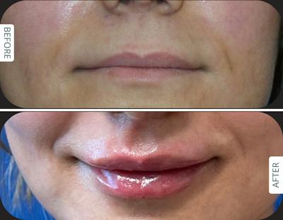 Miami Before and after Designer Deep Plane Lip Lift with fat transfer for natural lip volume enhancement in an international patient treated by Dr. Karan Chopra at Chopra Plastic Surgery in Miami. - The Chopra Plastic Surgery Center