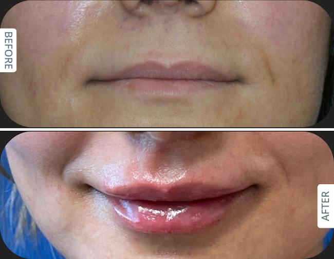 Before and after Designer Deep Plane Lip Lift with fat transfer for natural lip volume enhancement in an international patient treated by Dr. Karan Chopra at Chopra Plastic Surgery in Miami.