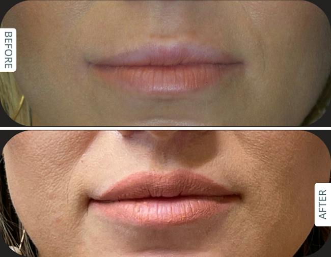 Before and after Designer Deep Plane Lip Lift in a female patient in her 30s, shown 6 months after surgery by Dr. Karan Chopra at Chopra Plastic Surgery.