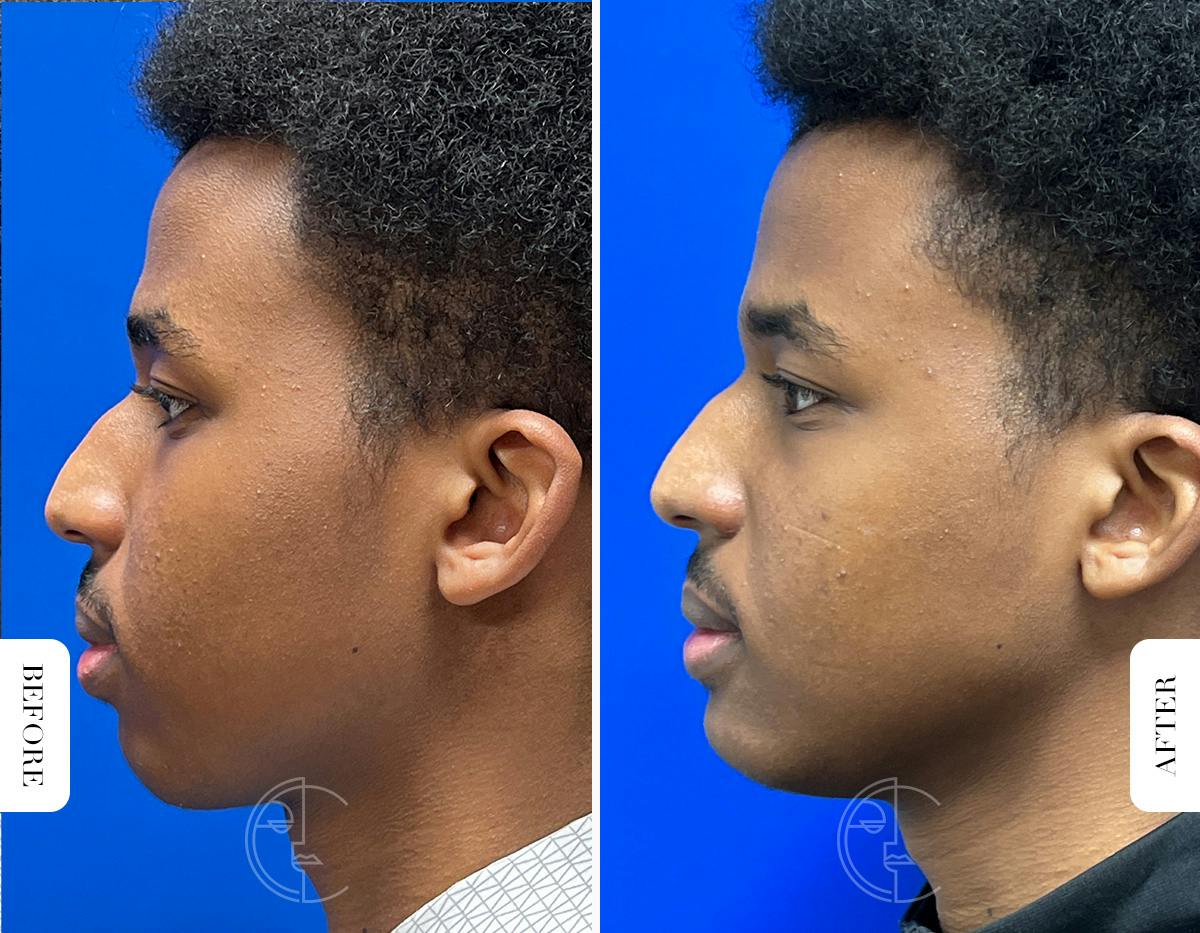 Miami Chin Augmentation Before & After Gallery - Patient 289564 - Image 3 - The Chopra Plastic Surgery Center